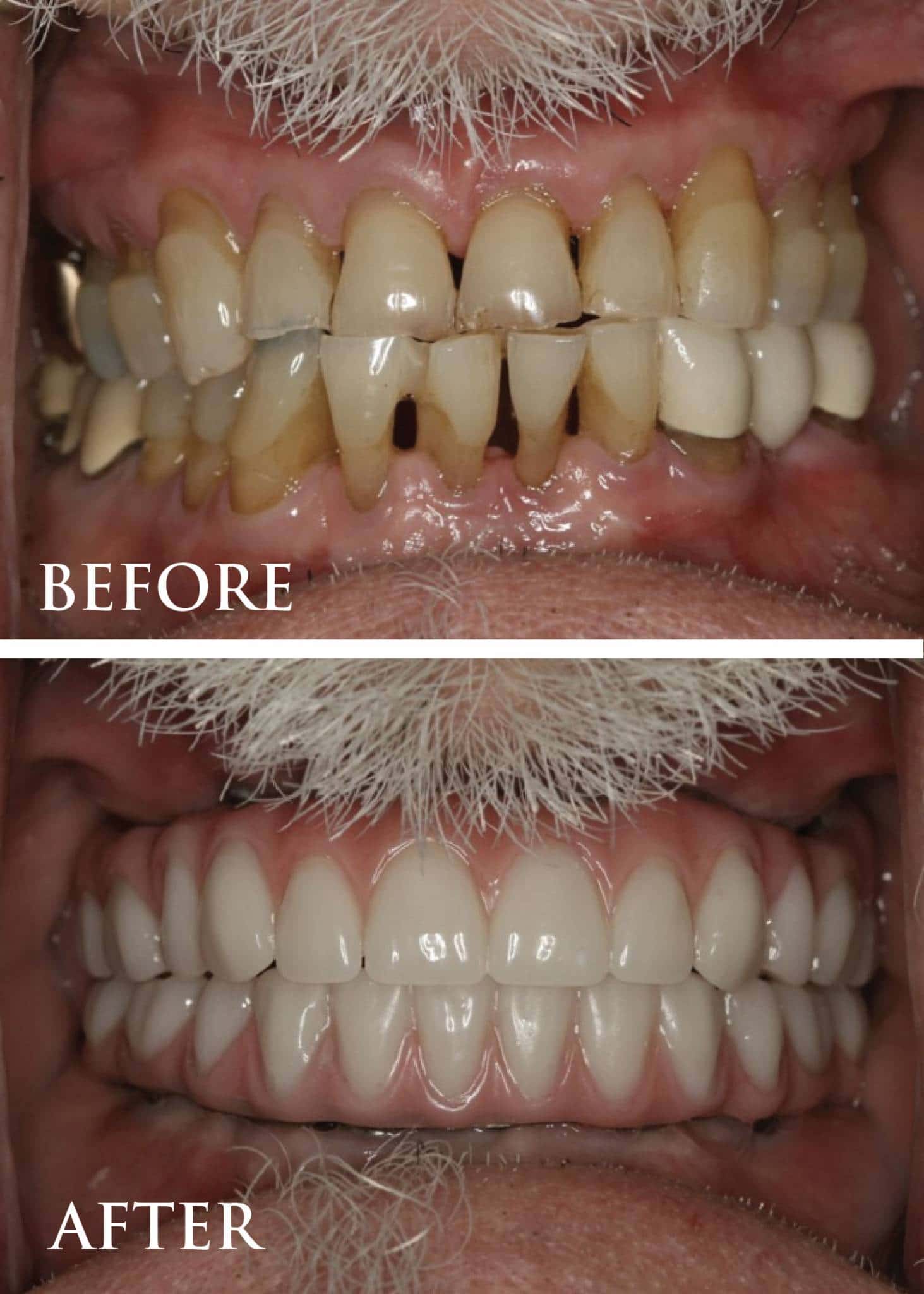 Smile Gallery Before And After Periodontal Therapy