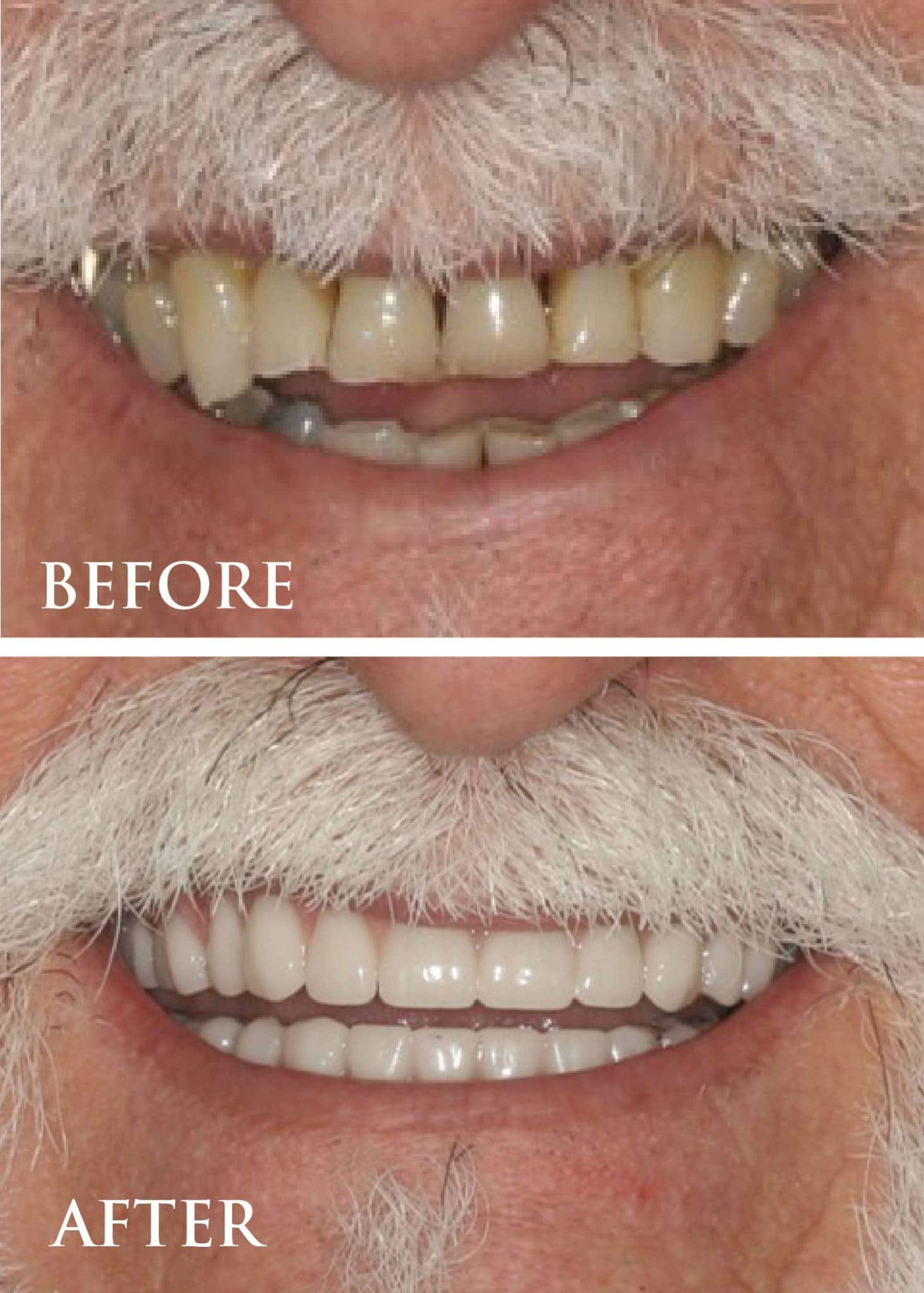 Full mouth restoration