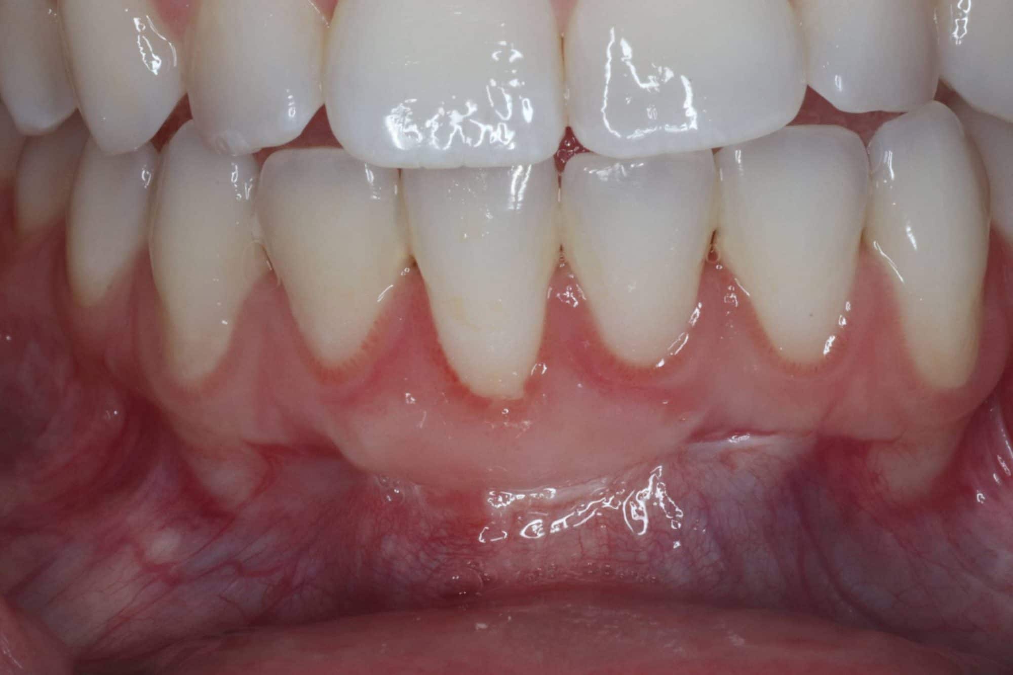 after - gingival grafting