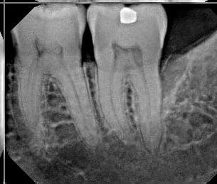 xray of two teeth with roots showing before